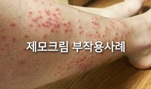 제모크림 부작용